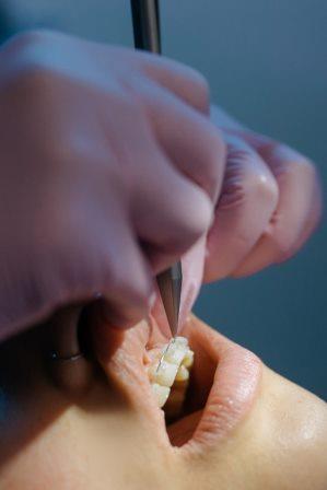 Dental sealants