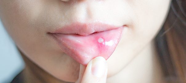 How to get rid of Canker Sores